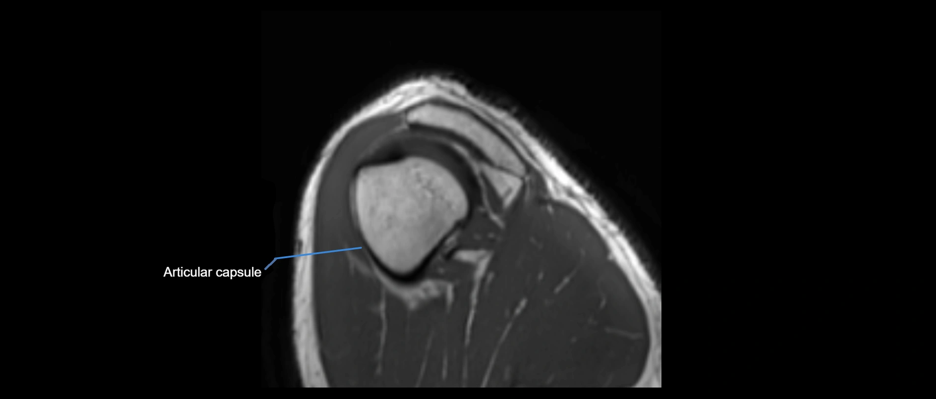 shoulder ligaments sagittal  cross sectional anatomy 3T MRI AI enhanced radiology image -img-00001-00050.webp